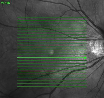 Optical Coherence Tomography Biomarkers in Predicting Treatment Outcomes of Diabetic Macular Edema After Dexamethasone Implants